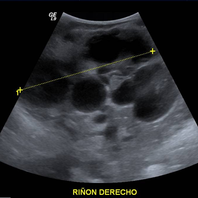 riñon derecho en ultrasonido