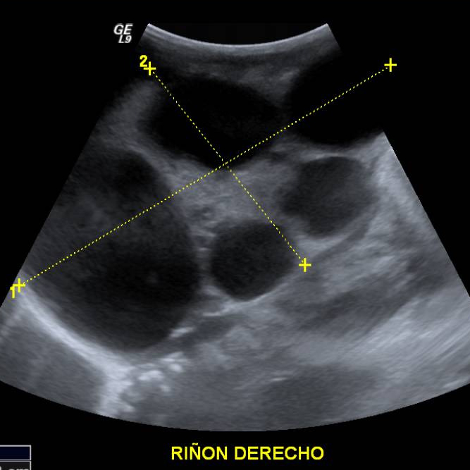 riñon derecho en ultrasonido