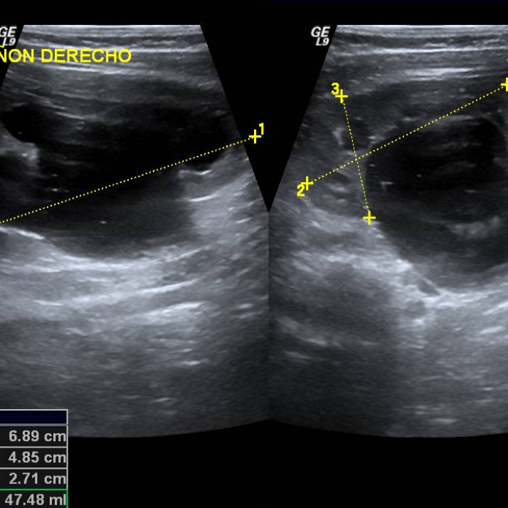 riñon en ultrasonido