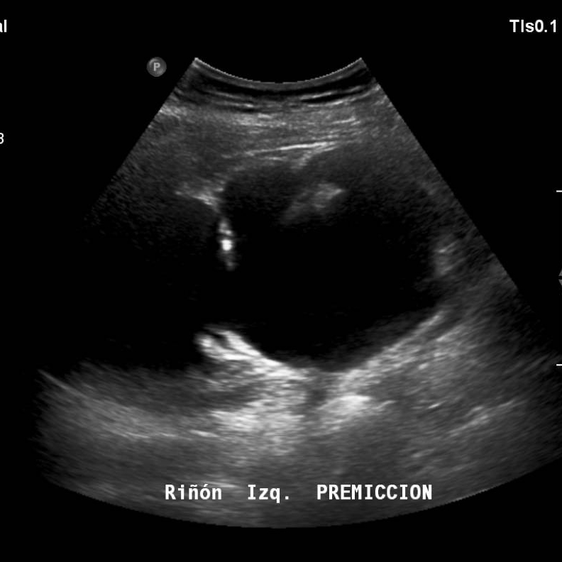 riñon izquierdo en ultrasonido